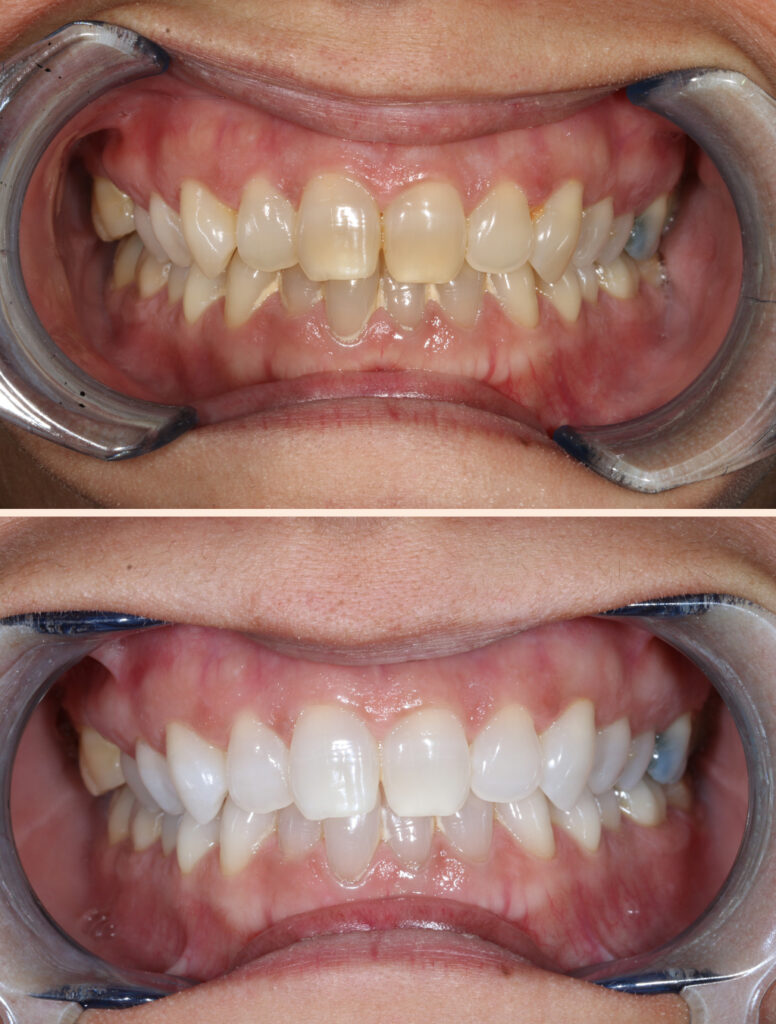 Blanqueamento dental en clínica dental Jesús Mora