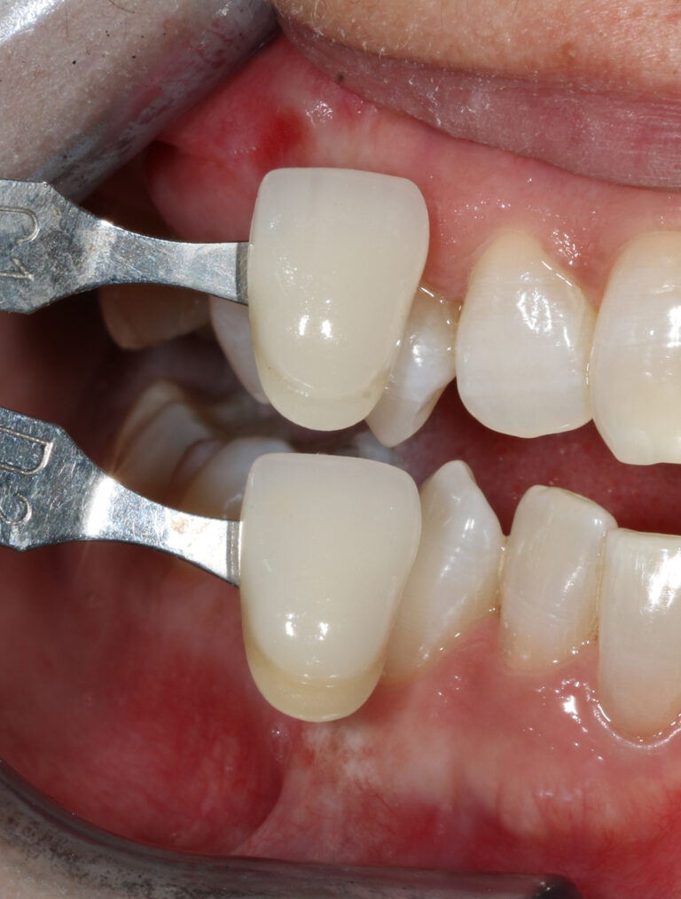 Blanqueamento dental en clínica dental Jesús Mora
