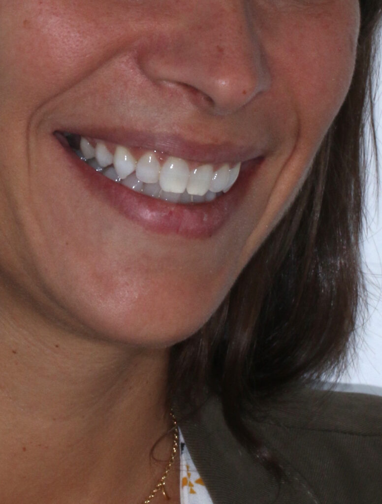 Blanqueamento dental en clínica dental Jesús Mora