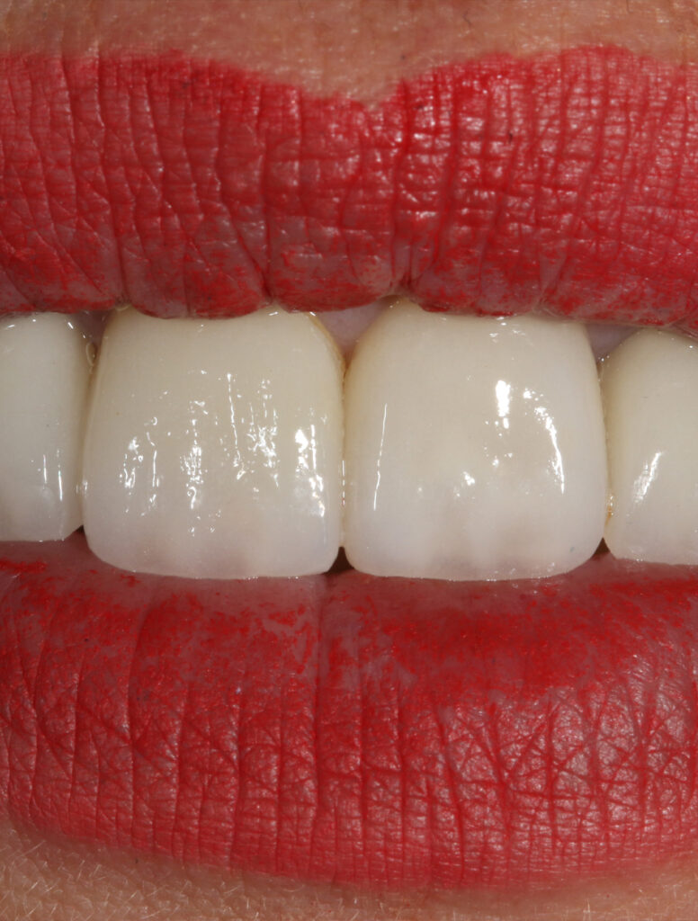 Estética dental en Jesús Mora
