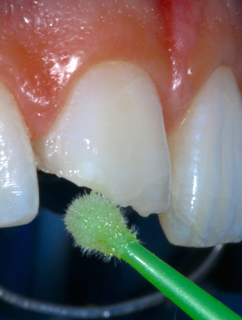 Estética dental en Jesús Mora