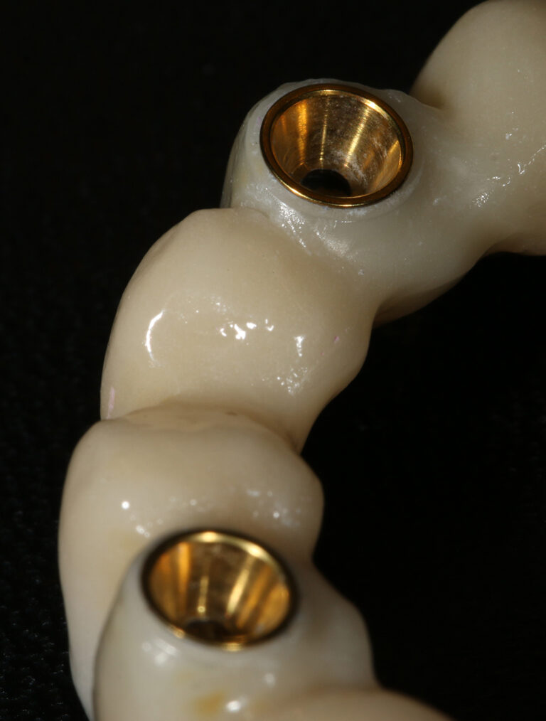 clinica-dental-jesus-mora-implantes-dentales-01
