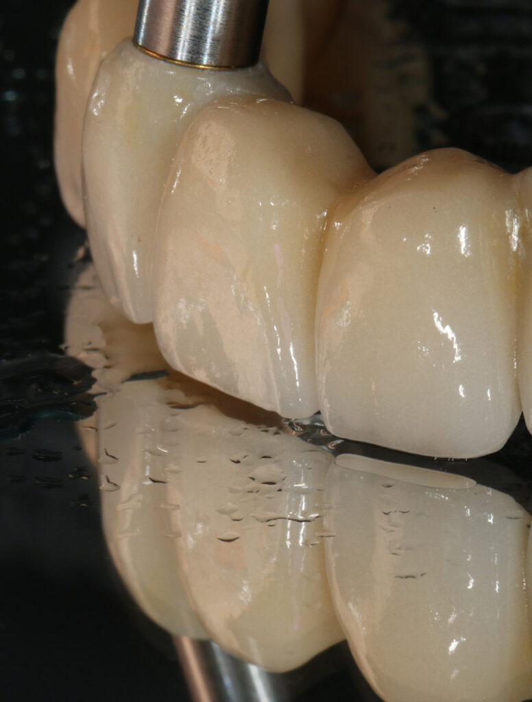 clinica-dental-jesus-mora-implantes-dentales-03