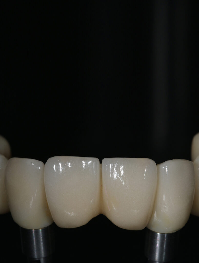 clinica-dental-jesus-mora-implantes-dentales-06