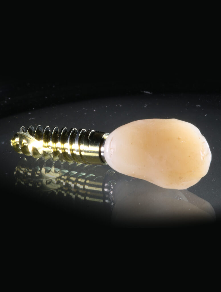 clinica-dental-jesus-mora-implantes-dentales-07